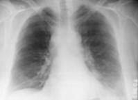 Radiographie thoracique montrant un élargissement du médiastin et un petit épanchement pleural gauche Radiographie thoracique montrant un élargissement du médiastin et un petit épanchement pleural gauche