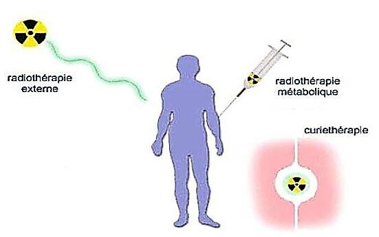 Trois mode de radiothérapie
