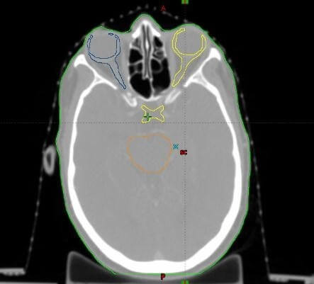 Evaluation dosimétrique - Contourage des volumes cibles (rouge) , et OAR (bleu, jaune orange).