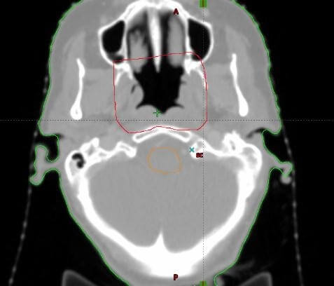 La technique 5 champs - Contourage des volumes cibles (rouge) , et OAR (bleu, jaune orange).