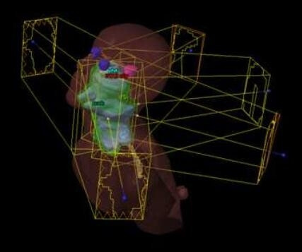 Illustration de l’ensemble des faisceaux de la technique 5 champs