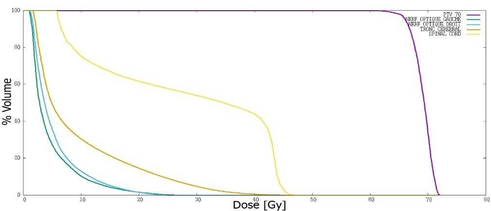 La technique 5 champs - Histogramme Dose Volume