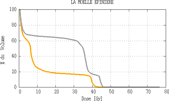 Comparaison d’histogramme dose volume de la moelle épinière