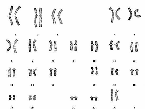 Caryotype normal d’un individu de sexe féminin