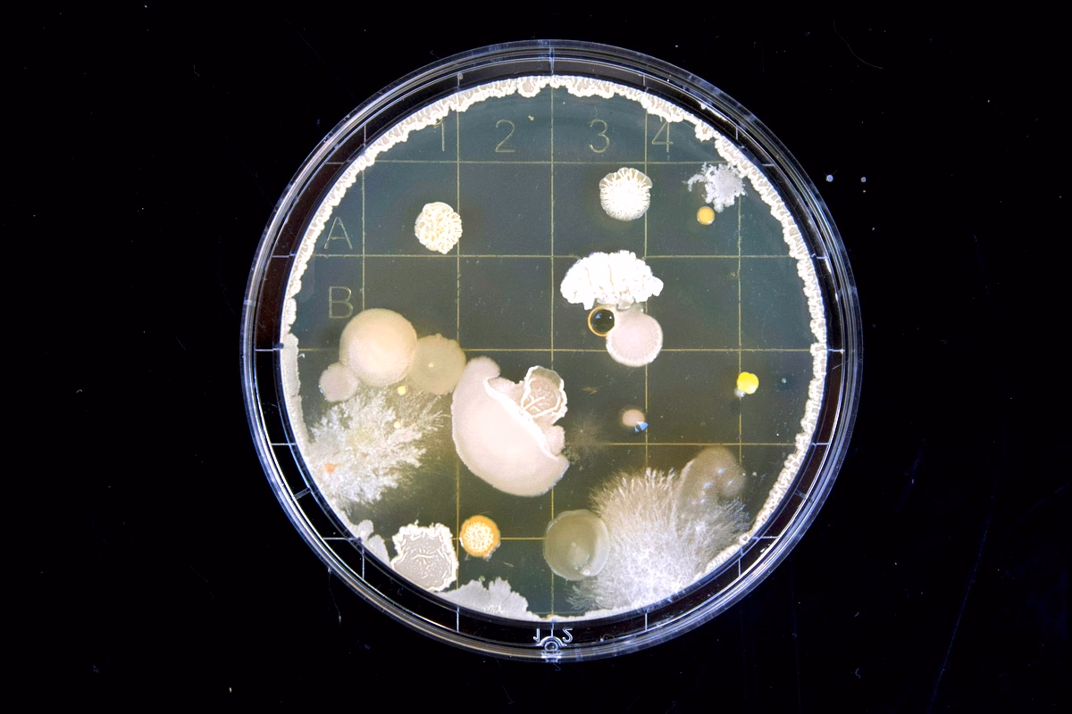 Marqueurs oxydatifs de la salive et parodontite agressive